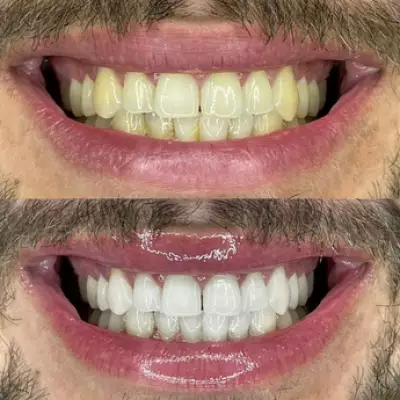 Smoker and Coffee Drinker Raves About 70p Teeth Whitening Strips