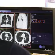 AI Detects Pancreatic Cancer Years Before Doctors in Breakthrough Study