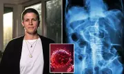 Bowel Cancer Rates Triple in Young Australians: Urgent Need for New Care Models