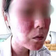 Bride Left 'Disfigured and Almost Blind' After Botched Microneedling