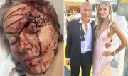 Charlie Teo's Partner Speaks Out After Skull Fracture Surgery While He Worked Abroad