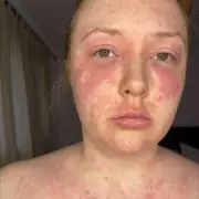 Eczema Sufferer's Life Transformed by Simple Red Light Therapy