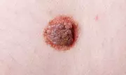 Global Melanoma Cases Predicted to Surge 50% by 2050, Study Warns