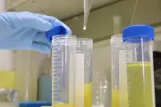 Innovative Urine Test for Early Lung Cancer Could Reach NHS in Five Years