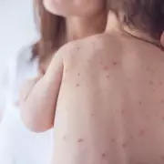 Measles Cases Surge in UK: Nearly 500 Confirmed in 2026