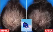 New Oral Minoxidil Shows Dramatic Hair Regrowth in Trial