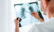 NHS Supermarket Screening Detects Thousands of Early-Stage Lung Cancers