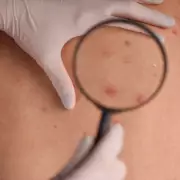 NHS Urges Skin Checks as Melanoma Kills Thousands Annually in UK