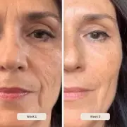Salon-Grade LED Mask with £220 Off for Youthful Skin in Two Weeks