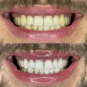 Smoker and Coffee Drinker Raves About 70p Teeth Whitening Strips