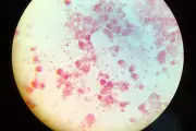 STI Cases Hit Record Highs in Europe as Gonorrhea and Syphilis Surge