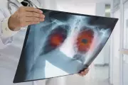 Supermarket Lung Cancer Checks Detect 10,000 Cases in England