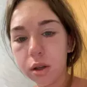 Teen's Face Swells 'Like Puffer Fish' from Kissing Disease