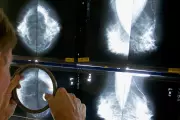 When Should You Get a Mammogram? Conflicting Advice Explained