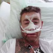 X Factor Star Christopher Maloney Warns Against Filler After Surgery