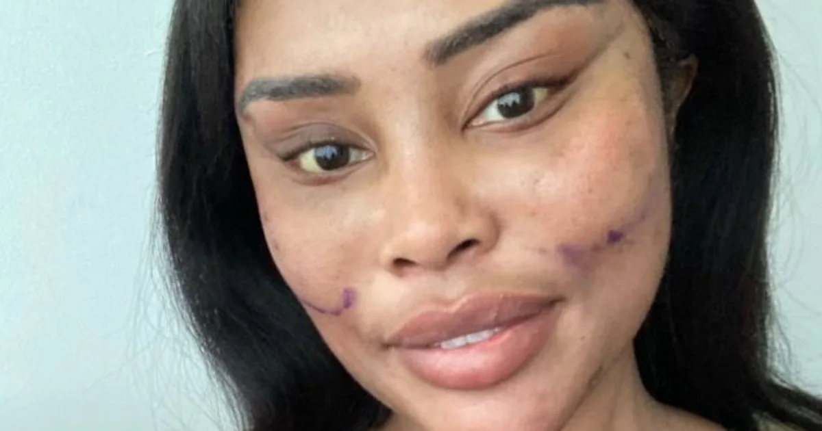 Woman, 28, spends £50k on facelift in Turkey: 'Worth every penny'