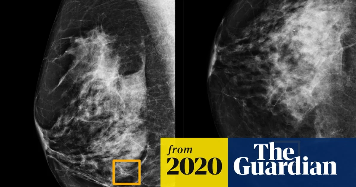 AI Outperforms Radiologists in NHS Scan Analysis Trial