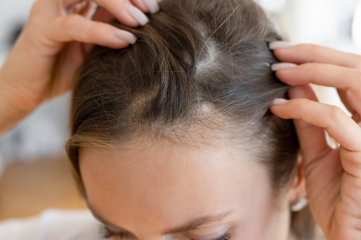 Baldness Classified As Disability In Tax Tribunal Ruling