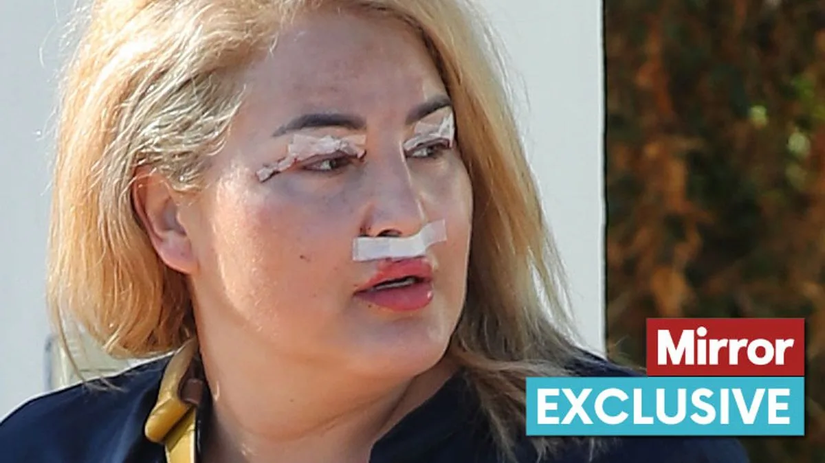 Big Brother Winner Nadia Almada Spotted with Stitches After Facelift in Spain