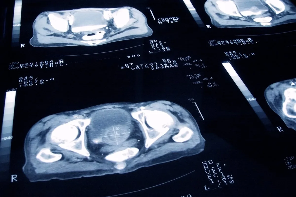 Saliva Test Could Revolutionise Prostate Cancer Detection, Study Finds