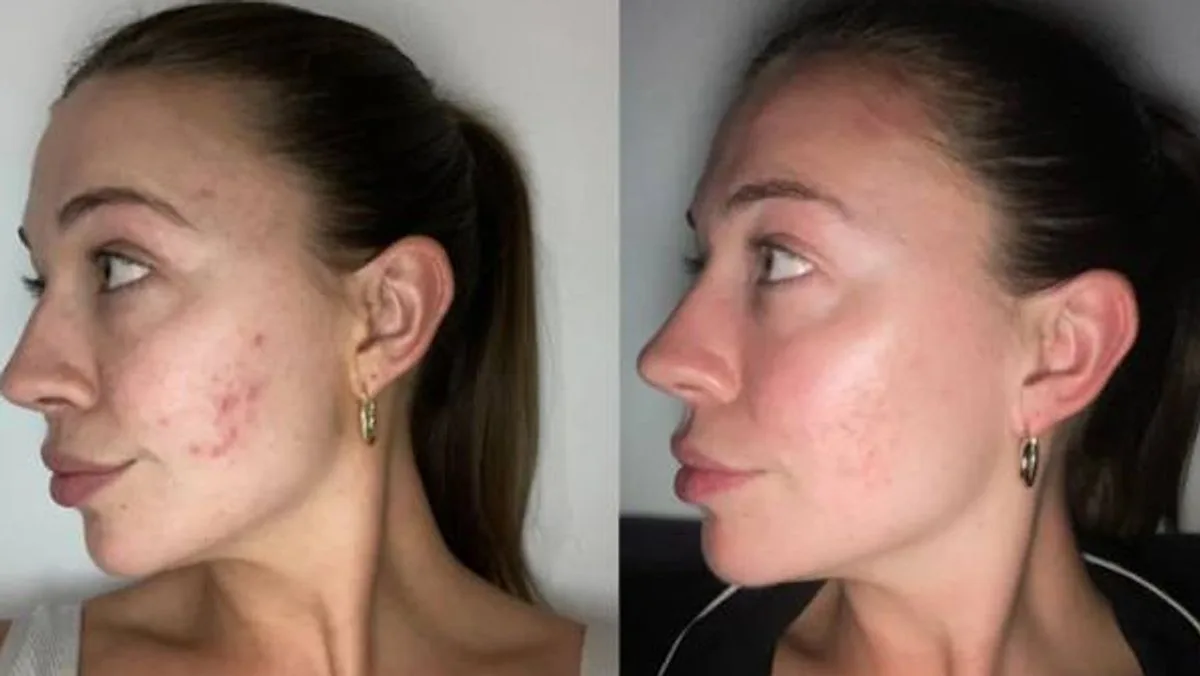 £11 Boots Spot Cream Hailed as 'Game Changer' for Acne-Prone Skin