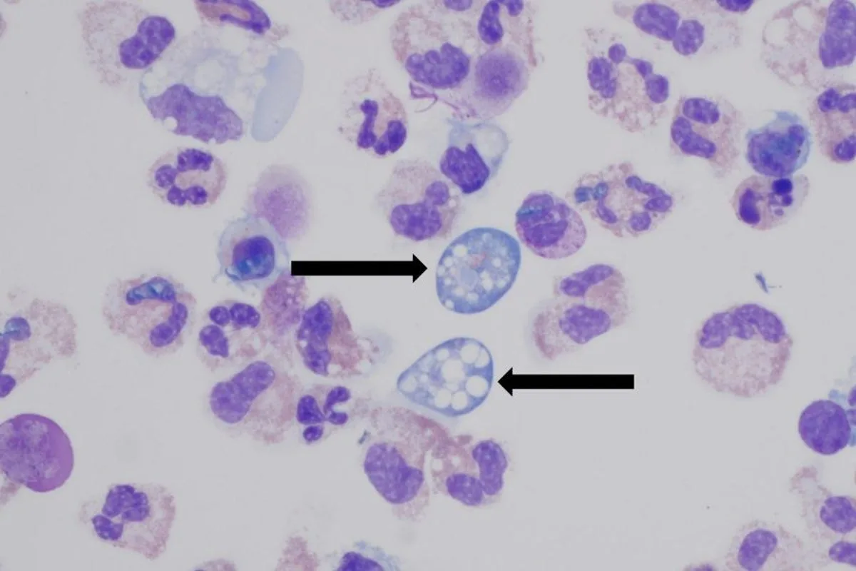 Boy, 12, Dies from Brain-Eating Amoeba After Hot Spring Visit