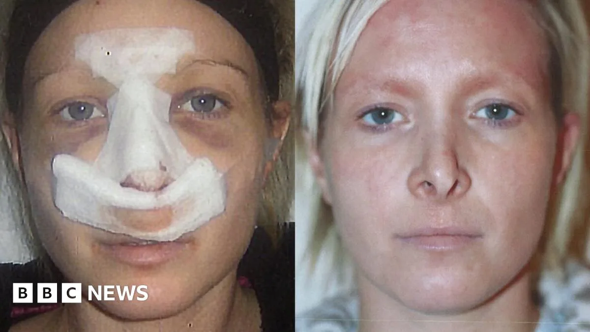 Cosmetic Surgeon Flies In from Abroad, Leaving Patients with Botched Results