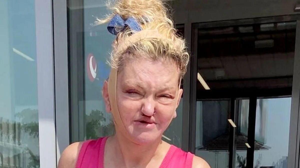 Danniella Westbrook Unveils Dramatic New Face After Reconstructive Surgery