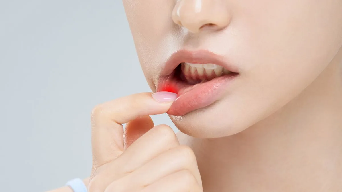 Mouth Ulcers That Won't Heal Could Signal Cancer, Dentist Warns