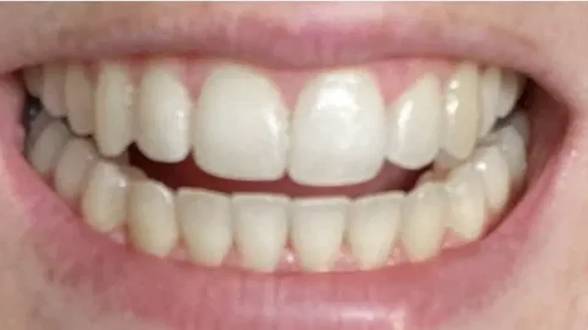 Dentist-Backed 95p Teeth Whitening Strips from Aldi Alternative Go Viral