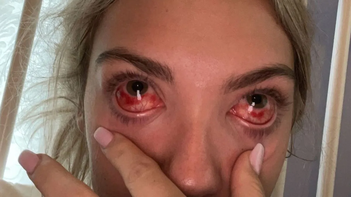 Woman Left 'Like a Zombie' After Severe Allergic Reaction to Eyelash Extensions