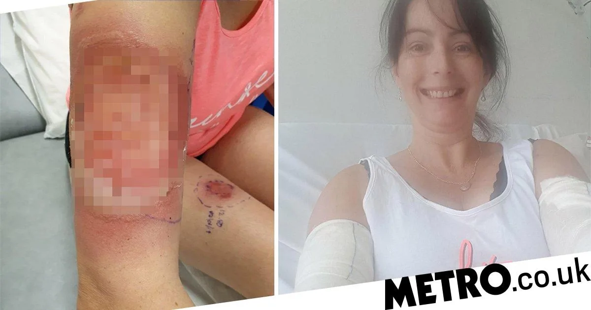 Mum Nearly Dies from Sepsis After Hot Tub Bacteria Infects Shaving Cut