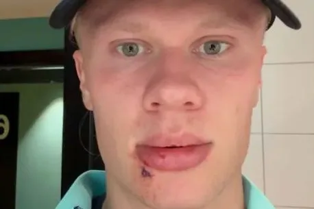 Haaland 'blames Odegaard' for freak injury suffered on international duty