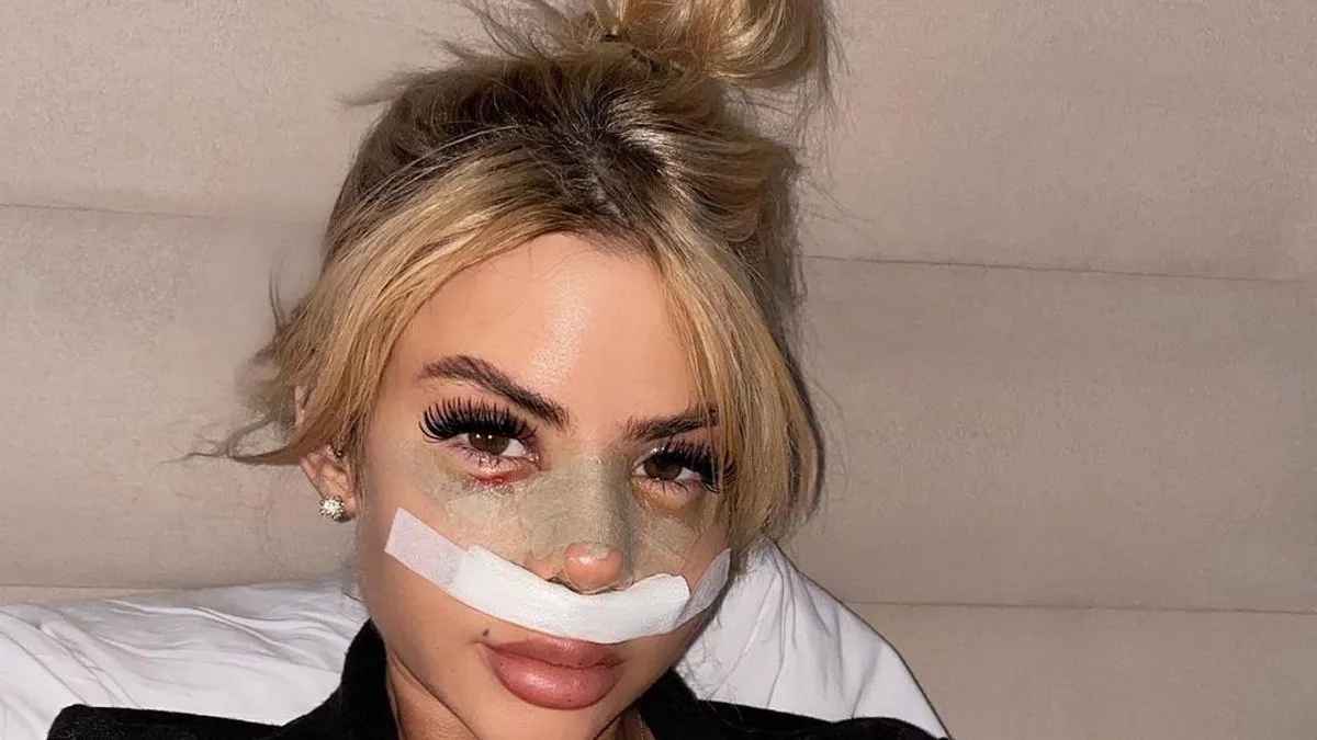 Love Island's Hannah Elizabeth Shows Off Nose Job Results After Turkey Surgery