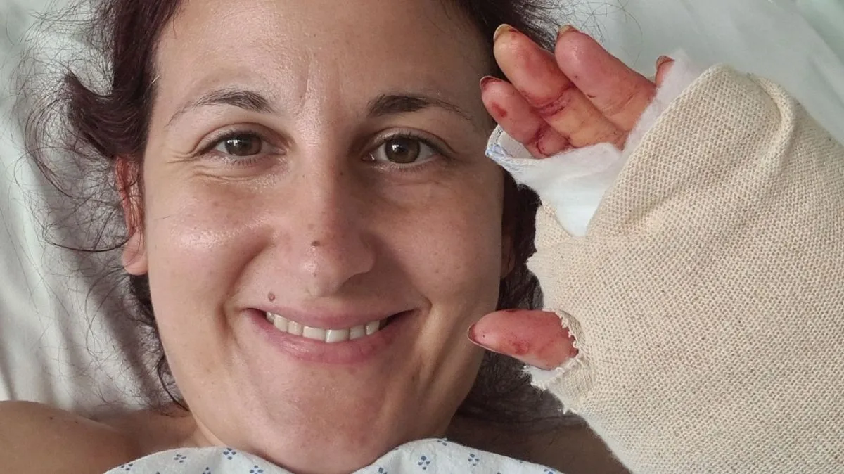 Holiday Seizure Leaves Woman with Severe Burns