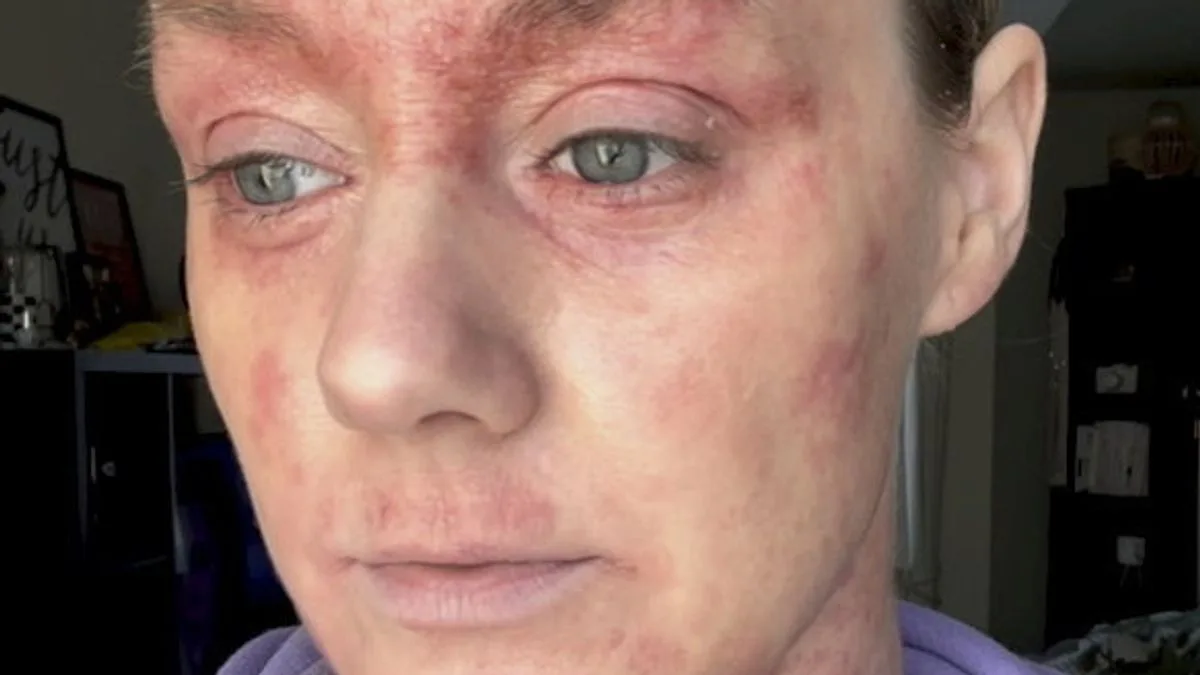Hundreds Report Severe Skin Condition TSW as Doctors Baffled