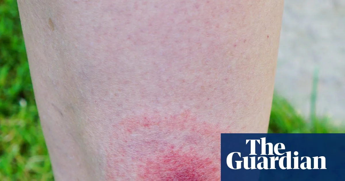 Lyme Disease Cases in England Rise by Over 20% in a Year