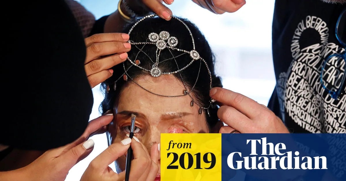 Model's Skin Deteriorates After Acid Attack