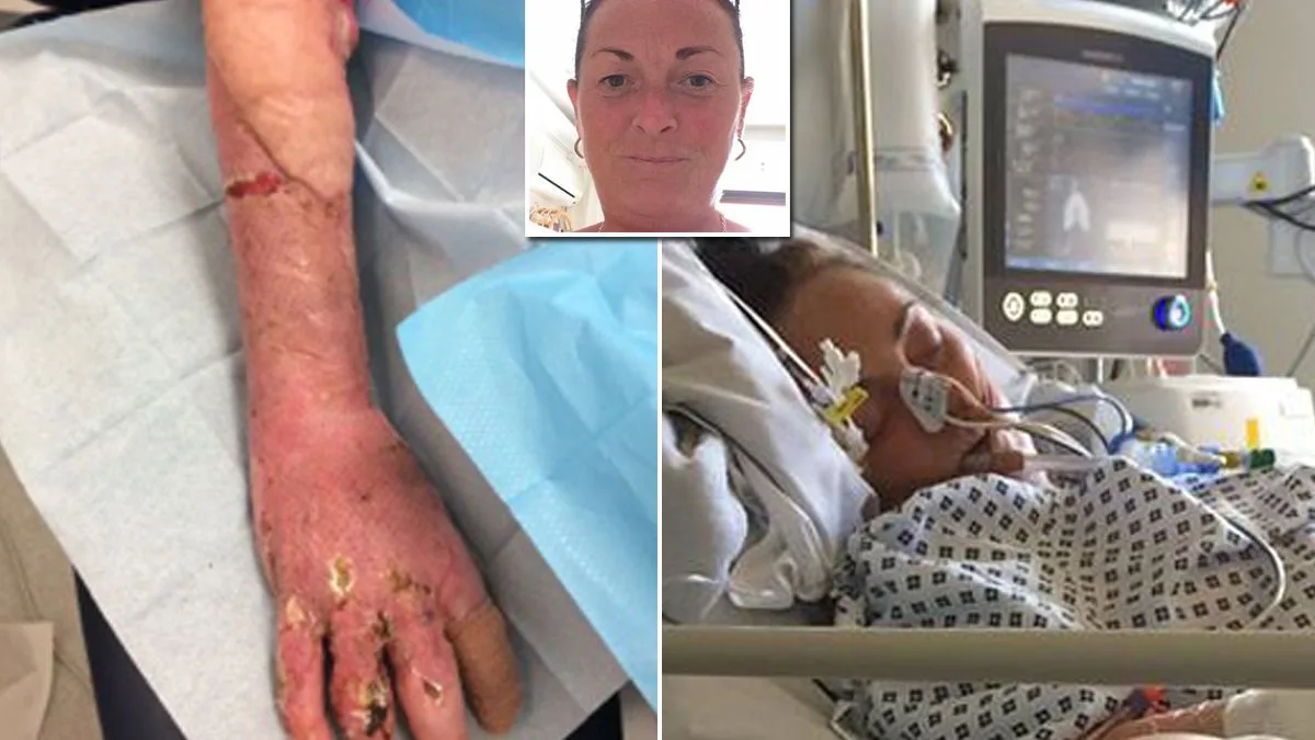 Mum's Sepsis Nightmare After Tiny Cut Nearly Kills Her