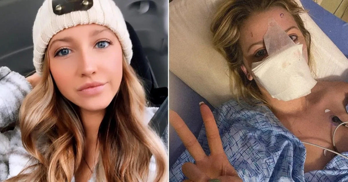 Woman's Nose Rebuilt Using Forehead Skin After Dog Attack