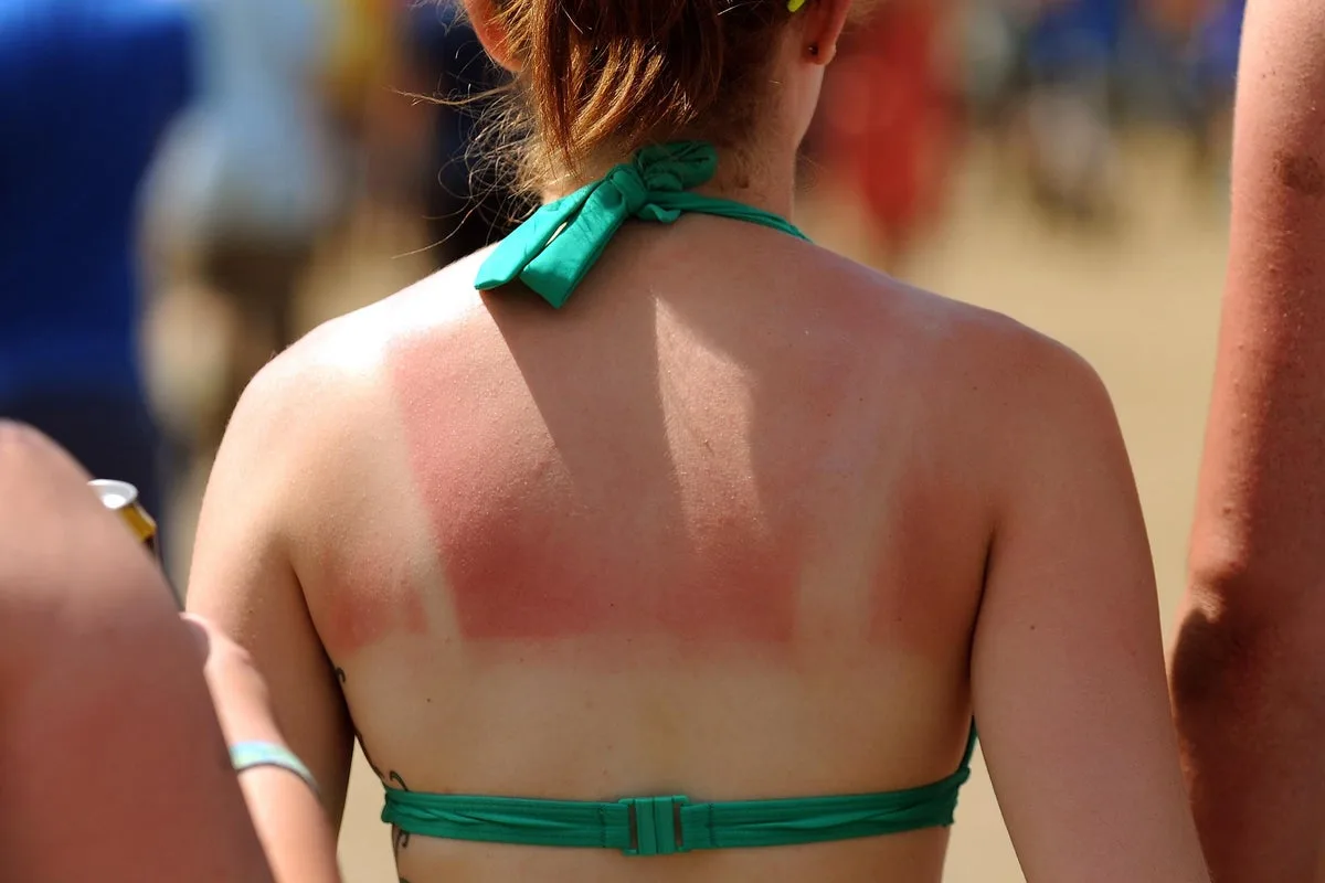 One in Nine Britons Admit Deliberate Sunburn for Tan