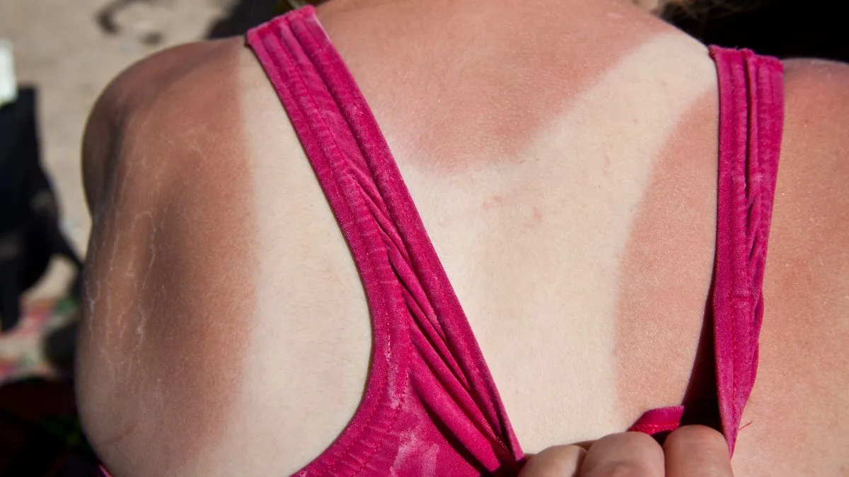 Skin Expert Reveals How to Repair Sun Damage After UK Heatwave
