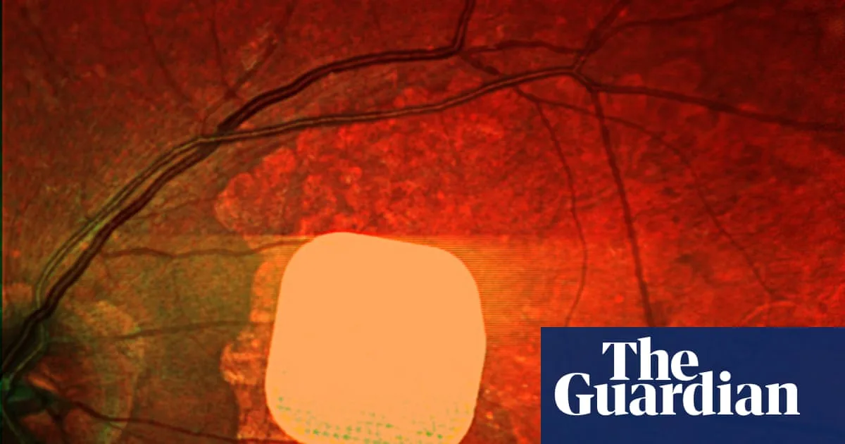 Electronic Eye Implant Restores Reading Vision to Blind Patients