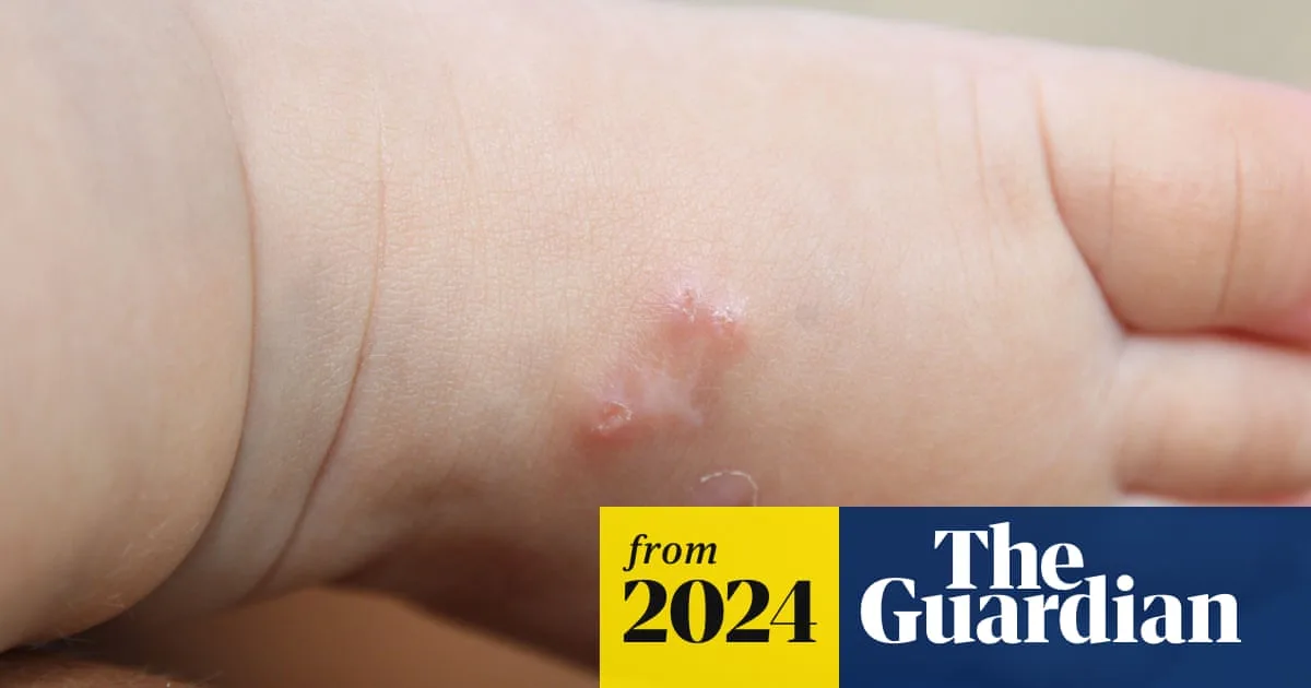 Scabies Cases Surge in UK Schools, Doctors Warn