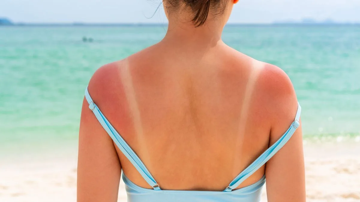 Skin cancers hit record high as Brits warned to be safe in sun this bank holiday