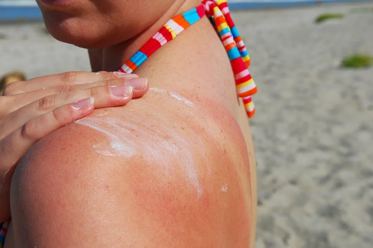 UK Melanoma Cases Hit Record High as Sun Safety Urged