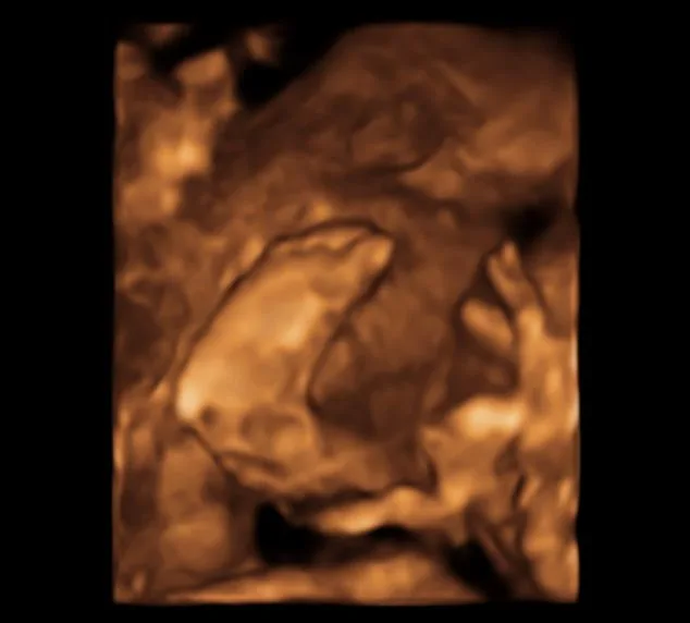 Unborn Babies Catch Yawns From Mothers Study Finds