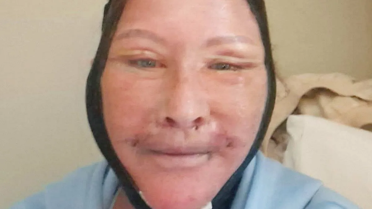 Woman Defends £6k Turkey Facelift After Trolls Mock ‘Kebab Shop’ Surgery