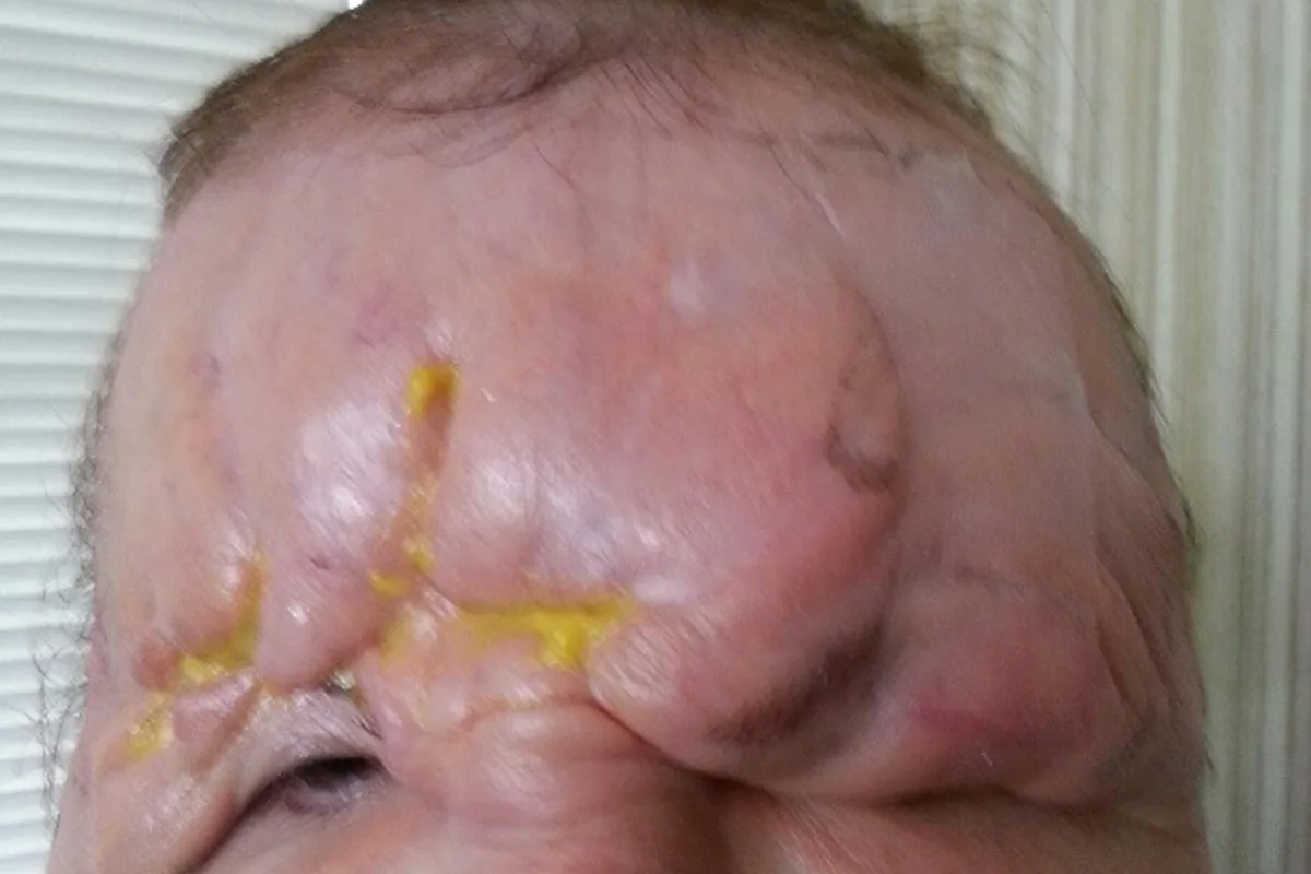 Woman Left Blind After Botched Dermal Fillers Warns of Dangers