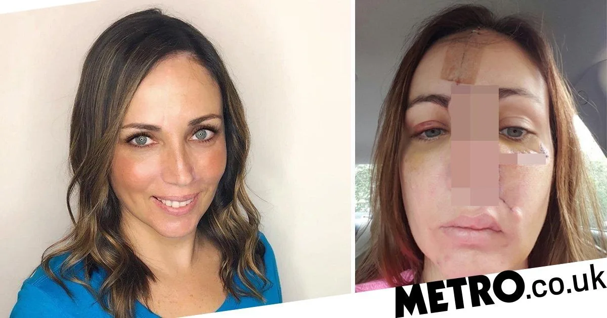 Woman's Forehead Used to Rebuild Nose After Spot Turns Out to Be Cancer